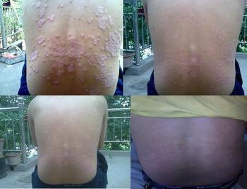 牛皮/癬的癥狀及圖片是什么樣子