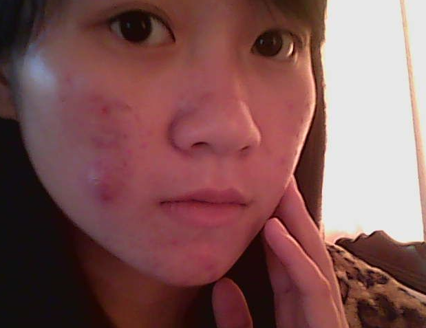 你知道青春痘圖片是什么樣子嗎?